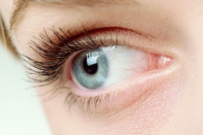 Model after receiving Eye Fillers